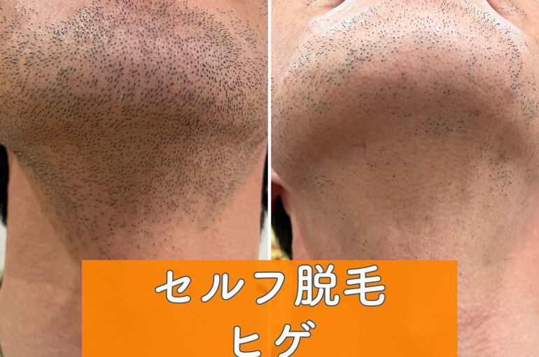 ヒゲ脱毛