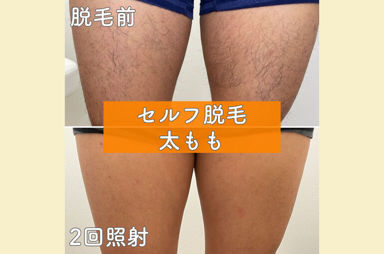 メンズの太もも脱毛